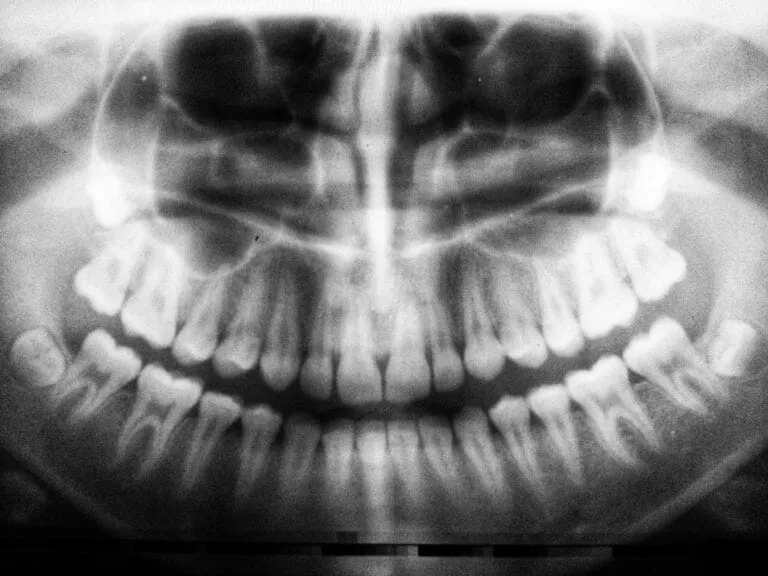 Implanturile dentare pot eșua? Photo Dental X-ray