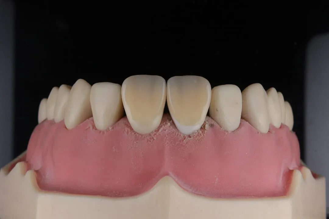 Photo Dental implant