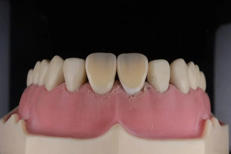 Implanturi dentare: soluția pentru un zâmbet de durată Photo Dental implant