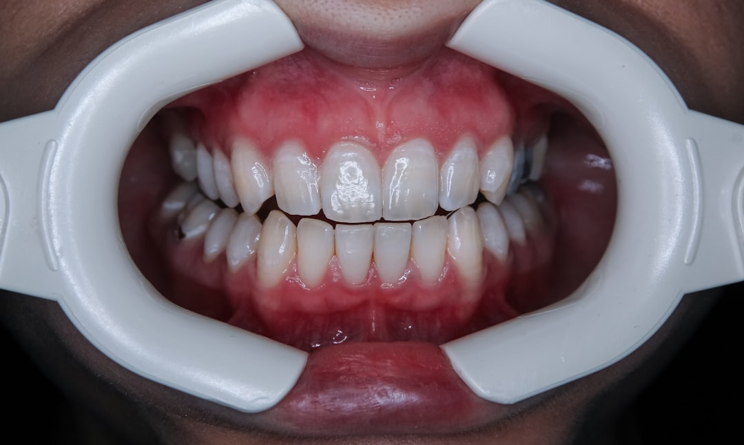 Photo dental filling