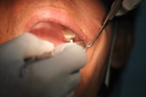 Photo implant dentar