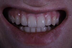 Photo whiten teeth at home