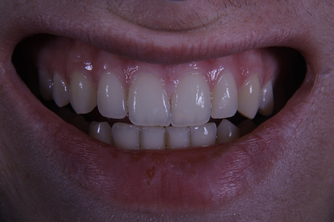 Photo whiten teeth at home