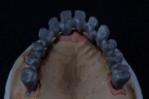 Photo dental prosthetics