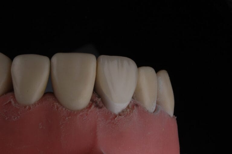 Photo stains on teeth