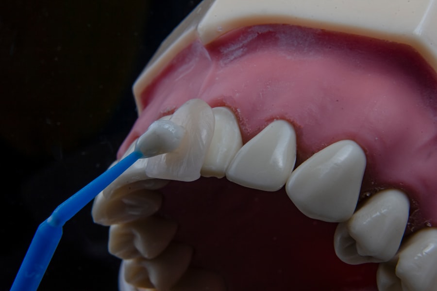 dental implant