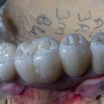 Implantul dentar: soluția ideală pentru dinții lipsă