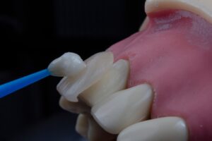 Photo dental implant