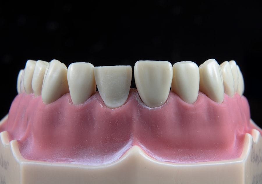 Photo dental implant