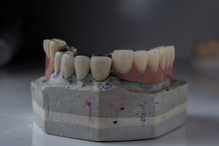 Photo implant dentar cu încărcare imediată
