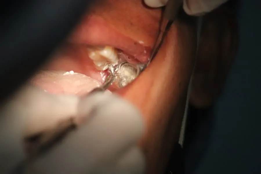 implant dentar