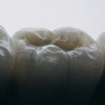 Durabilitatea implantului dentar: întreținere corectă pentru rezistență maximă