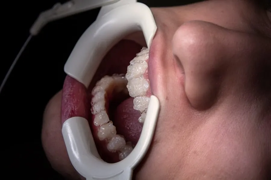 Photo implant dentar