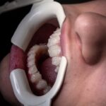 Ce să faci în caz de durere după implant dentar