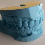 Implant dentar și proteză fixă: cum funcționează împreună