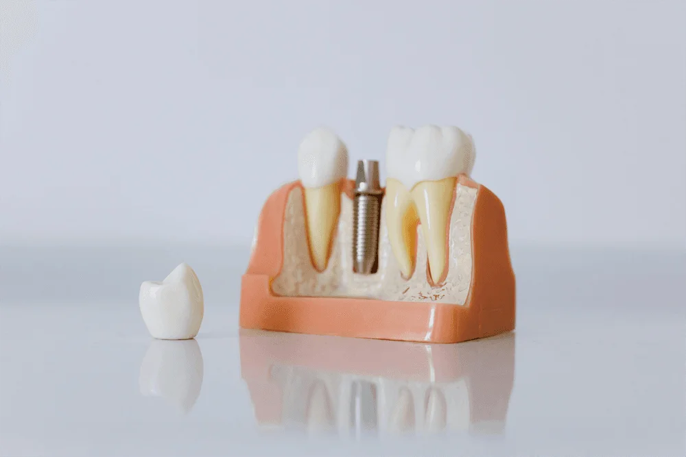 Ce soluție există pentru înlocuirea unui dinte pierdut? Implant dentar la clinica Dental Premier din București