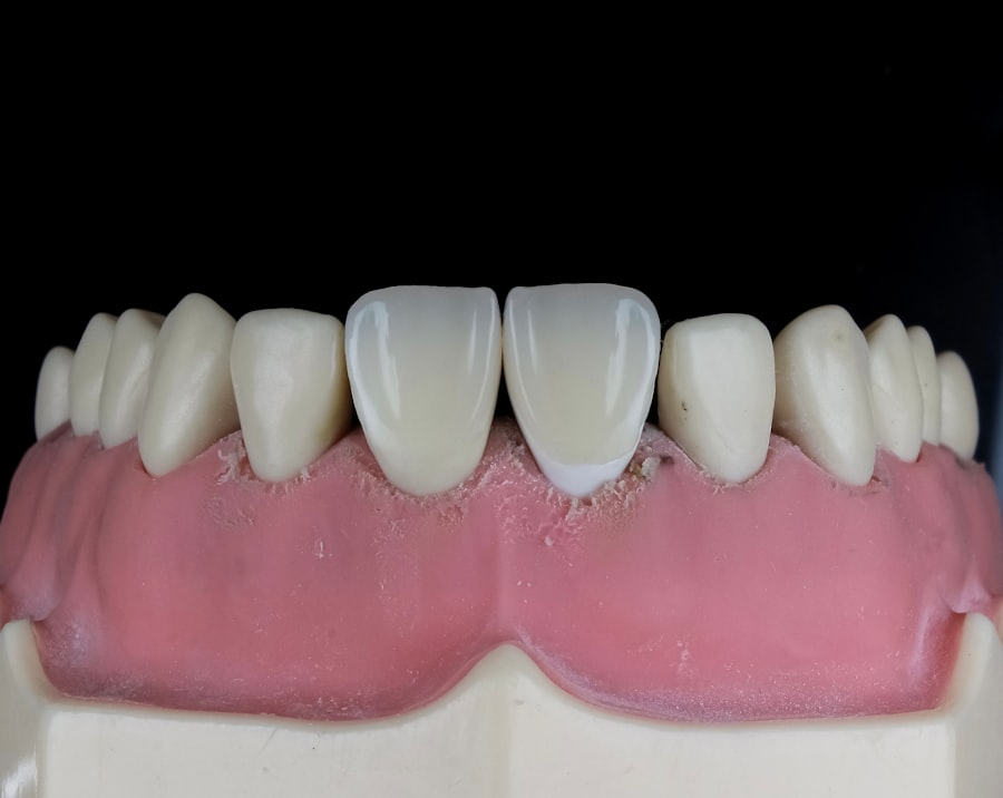 implant dentar