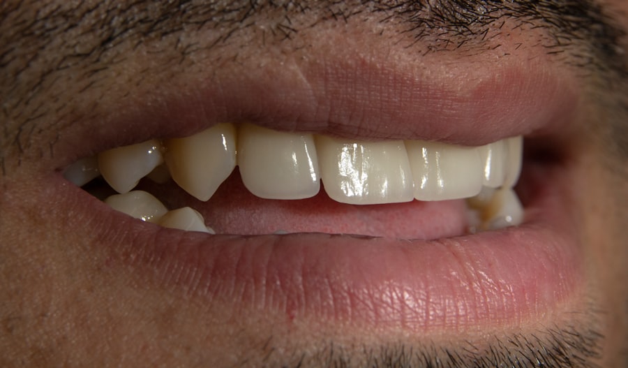 Photo implant dentar