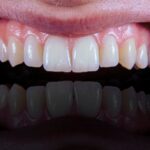 Ce alimente să eviți după implant dentar