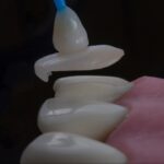 Etapele complete ale inserării implantului dentar