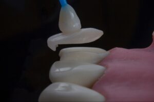 Photo implant insertion procedure stages