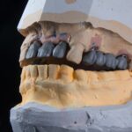Implant dentar și osteoporoza: evaluarea necesară