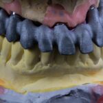 Implant dentar la vârstnici: limite și beneficii