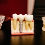 Ce alimente sunt permise după implant dentar