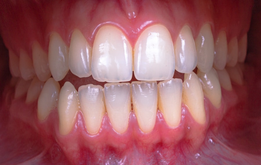 implant dentar