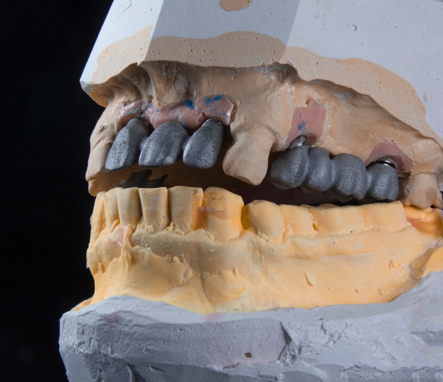 implant dentar