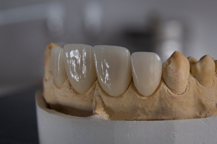 implant dentar