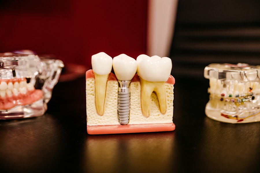 Photo Implant dentar