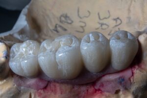Photo implant success rate