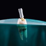 Implant dentar la tineri: momentul potrivit