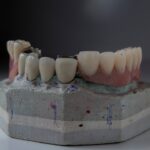Factori care influențează prețul unui implant dentar