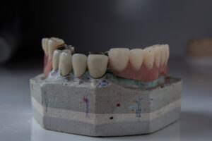 Photo implant dentar