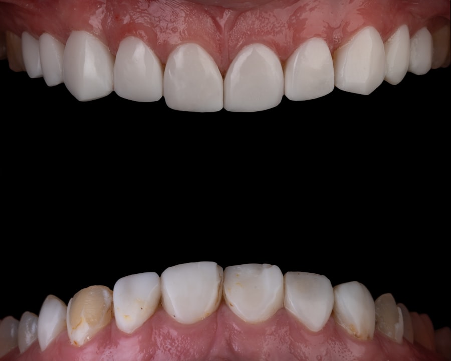 Photo implant dentar