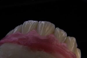 Photo implant treatment planning