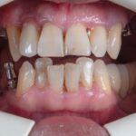 Igiena orală după implant dentar