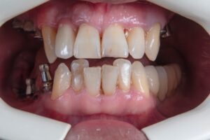 Photo oral hygiene after implant