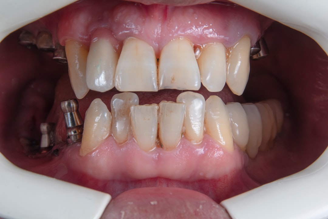 Photo oral hygiene after implant