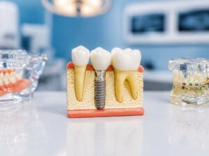 Photo implant success