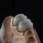 Rolul coroanei dentare pe implant pentru estetică