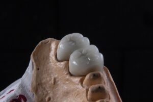 Photo dental crown on implant