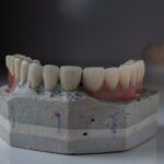 Montarea coroanei pe implant dentar: momentul potrivit