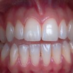 Implant dentar sau proteză mobilă: cum faci alegerea corectă?