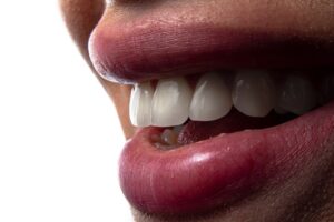 Photo implant dentar