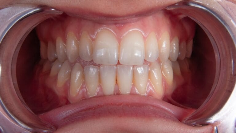 Photo implant dentar frontal