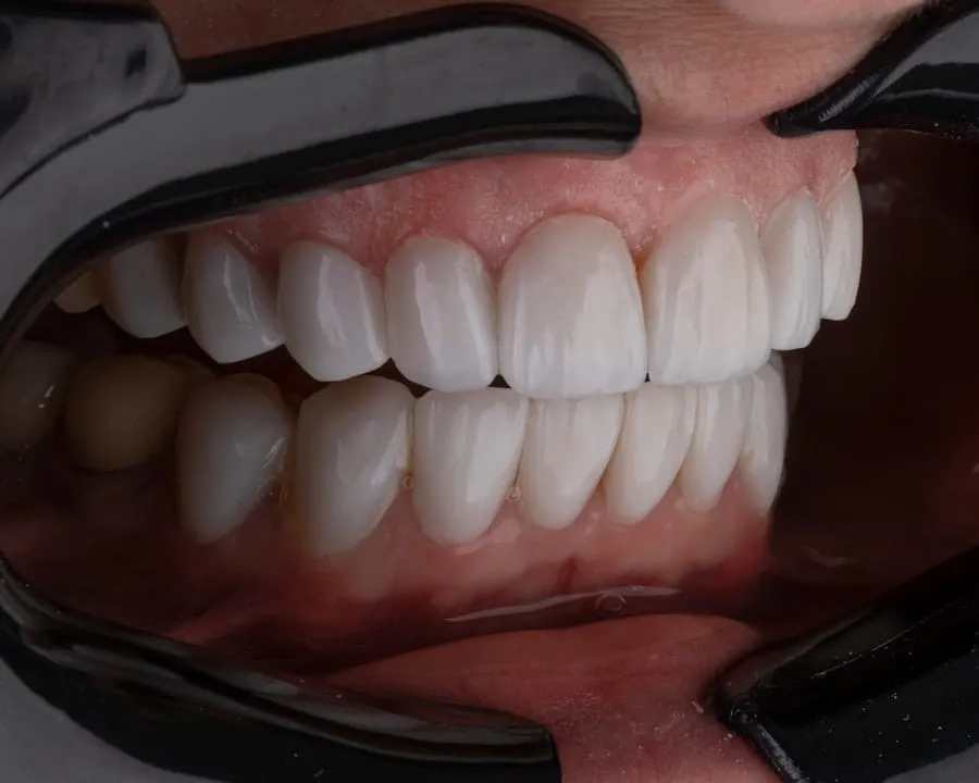 Photo implant dentar