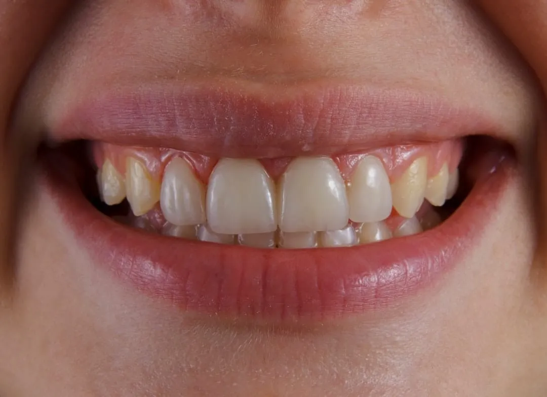 Photo implant dentar